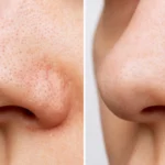 Before and after for nose blackheads