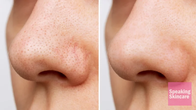 Before and after for nose blackheads