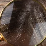 Dandruff in hair
