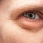 A close up of a puffy eye