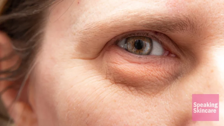 A close up of a puffy eye