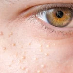 Chicken skin under an eye