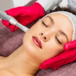 A woman having a micro needling treatment