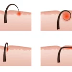 Picture of ingrown hair