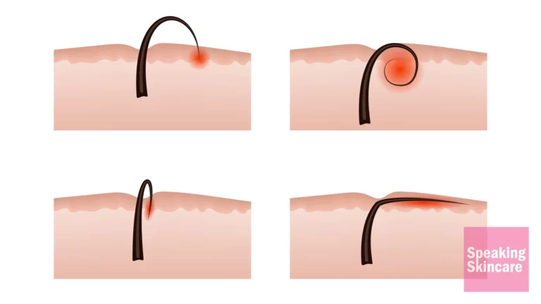 Picture of ingrown hair