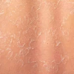 Ashy skin