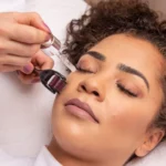 A woman getting a microneedle