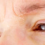 how to get rid of dry skin on eyebrows