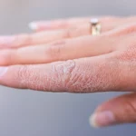 how to remove dry skin from hands