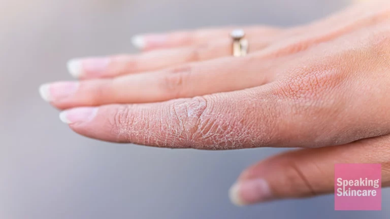 how to remove dry skin from hands