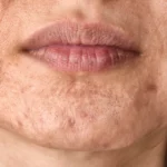 congested skin