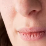 home remedies for chapped lips