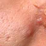 how to get rid of peeling skin on nose