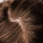 Scalp Exfoliation: How To Remove Dead Skin From Your Scalp