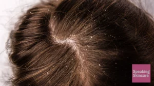 Scalp Exfoliation: How To Remove Dead Skin From Your Scalp