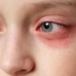why is the skin around my eyes red