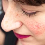 what causes blotchy skin