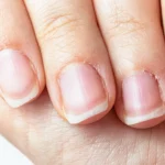why is the skin around my nails peeling