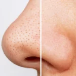 how to get rid of blackheads on nose