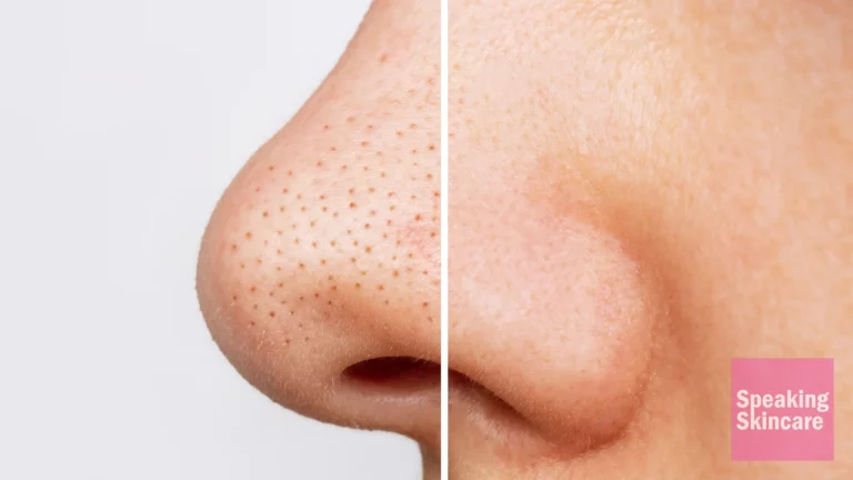 how to get rid of blackheads on nose