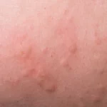 bumps on face