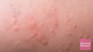 bumps on face