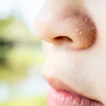 how to get rid of dry flaky skin around nose