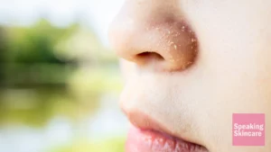 how to get rid of dry flaky skin around nose