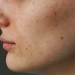 what are liver spots