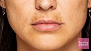 How to get rid of dark spots on lips